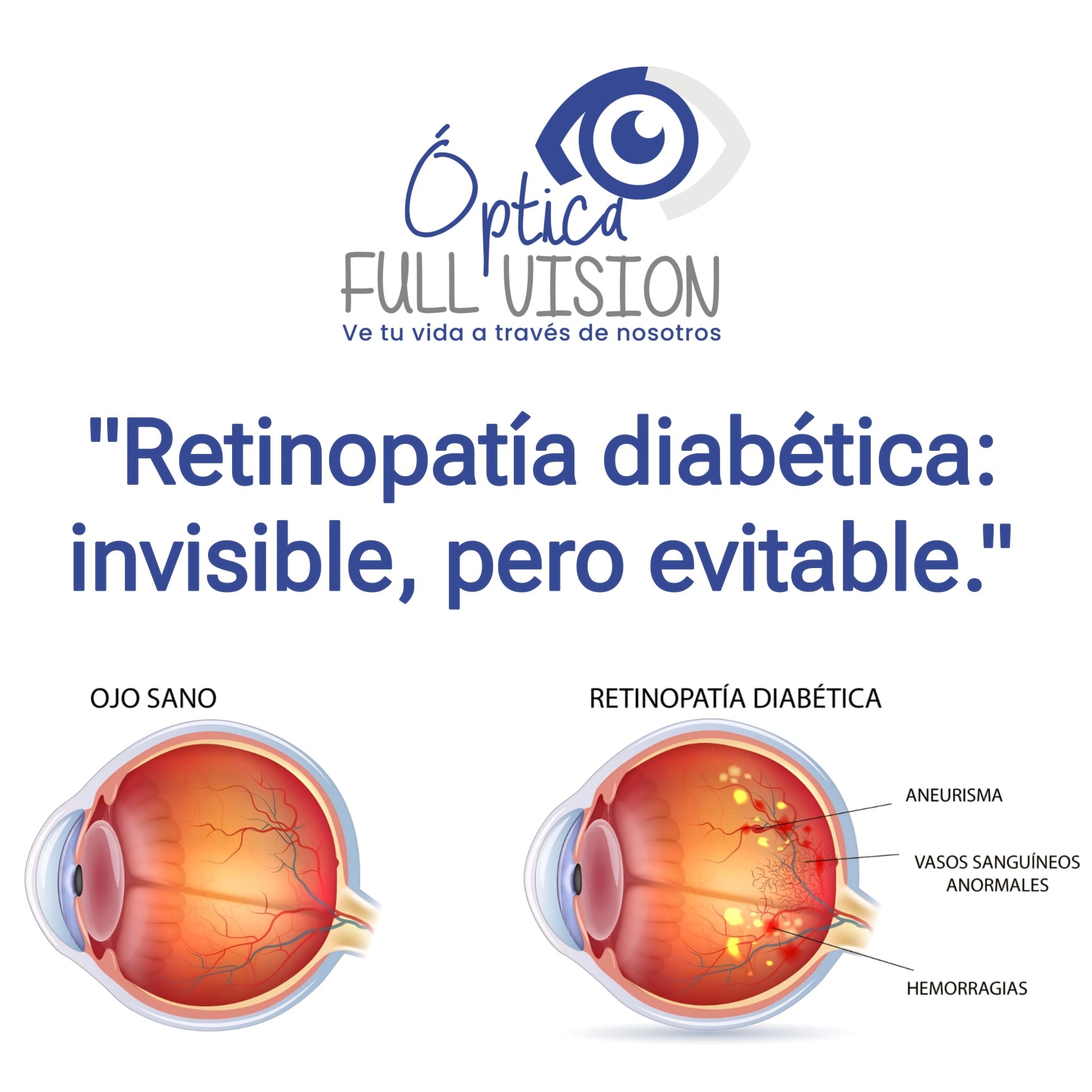 Información sobre retinopatía diabética